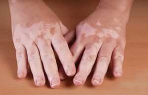 Vitiligo: entenda o que é e como tratar