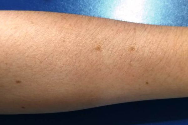 É importante ficar atento e observar sinais e manchas suspeitas