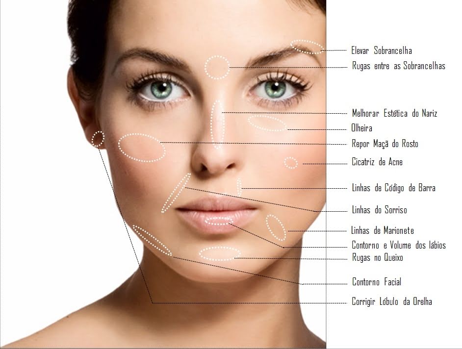 L‡bios s‹o preenchidos com ‡cido hialur™nico