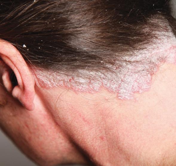 Psoríase é uma doença inflamatória crônica da pele, sistêmica, de base genética, não contagiosa