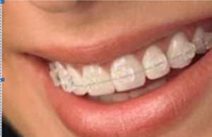 Dia do Dentista: Aparelho Ortodôntico Estético: perguntas frequentes